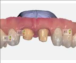Dental Impression Systems