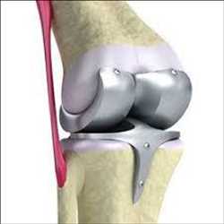 Knee Reconstruction Devices