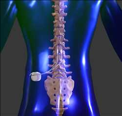 Spinal Cord Stimulators